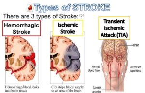 stroke types